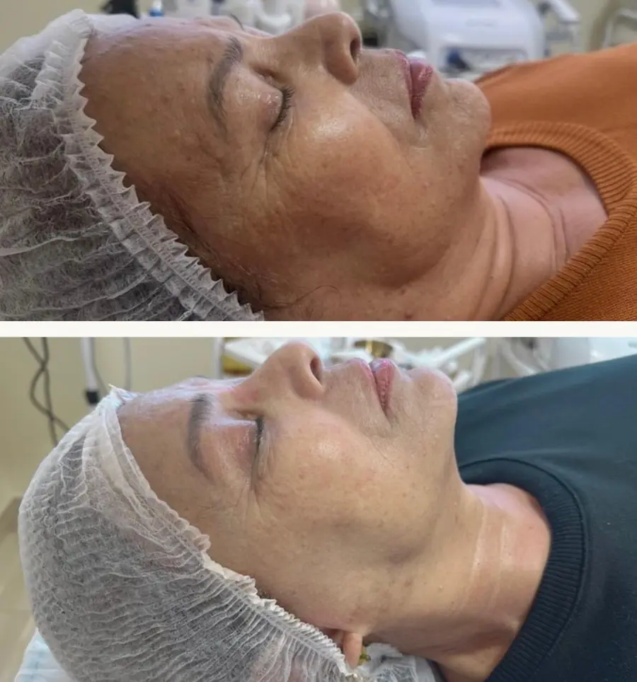 Caso real 08: Rejuvenescimento, textura e qualidade de pele.